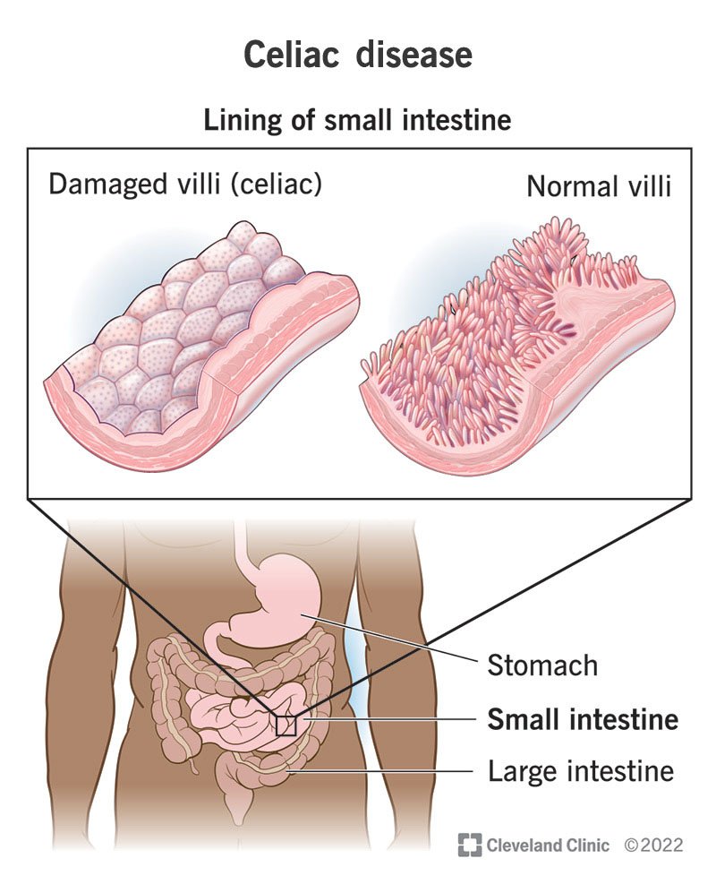 Celiac disease is a chronic autoimmune disorder triggered by gluten consumption. Gluten is a protein found in wheat, barley, and rye.