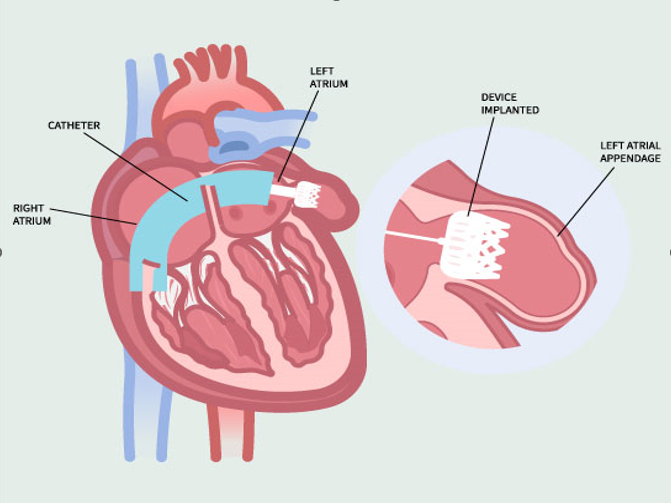 Diagram showing the left atrial appendage of the heart highlighting its structure and role in atrial fibrillation-related clot formation